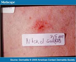 A Nickel For Your Thoughts Contact Dermatitis Allergens And Food Allergy Highland Park Il Consultants In Allergy Asthma Care